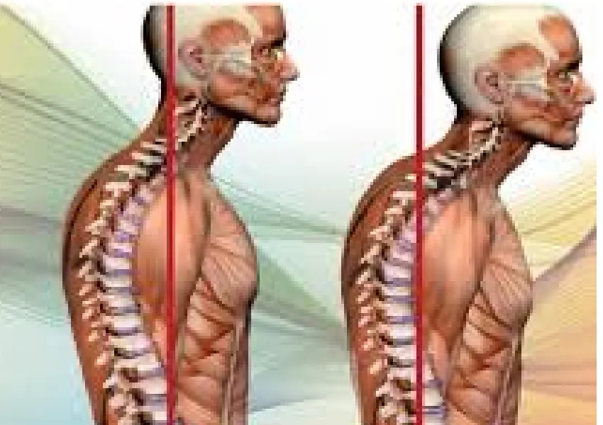 The Digital Generation Neck Hump: Why Early Intervention Can Prevent ...